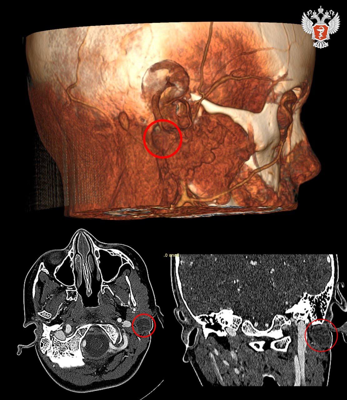 Врачи РДКБ Минздрава России удалили ребенку редчайшее образование за ухом Врачи РДКБ Минздрава России удалили ребенку редчайшее образование за ухом