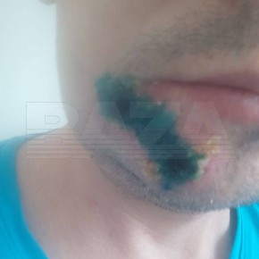 В Подмосковье зафиксирован подтверждённый случай оспы обезьян