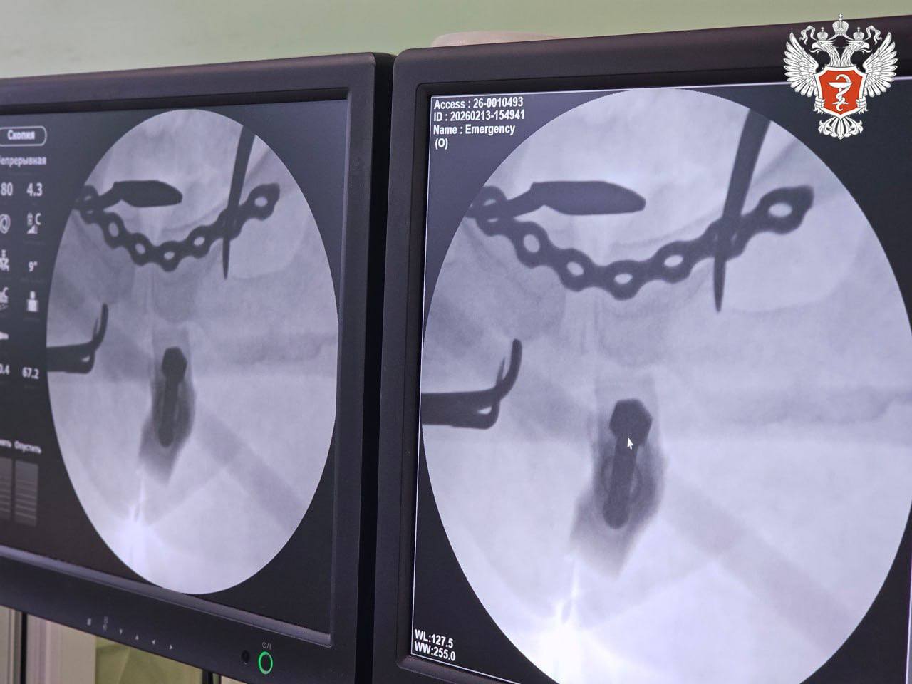 Воронежские травматологи сохранили женщине возможность ходить после тяжёлой травмы на тюбинге Воронежские травматологи сохранили женщине возможность ходить после тяжёлой травмы на тюбинге